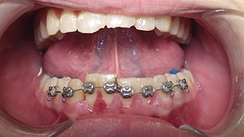 Straight Talk: Extrusion Trauma and a Root Fracture