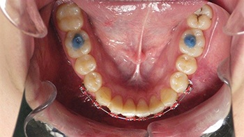 Straight Talk: Extrusion Trauma and a Root Fracture