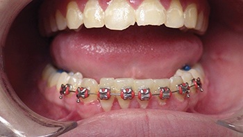 Straight Talk: Extrusion Trauma and a Root Fracture