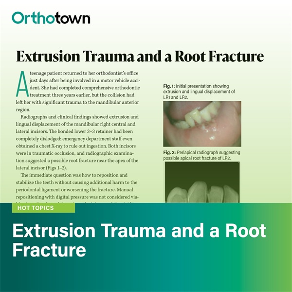 Extrusion Trauma and a Root Fracture