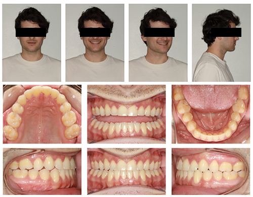 The Power of Anterior-Posterior Control with Clear Aligners