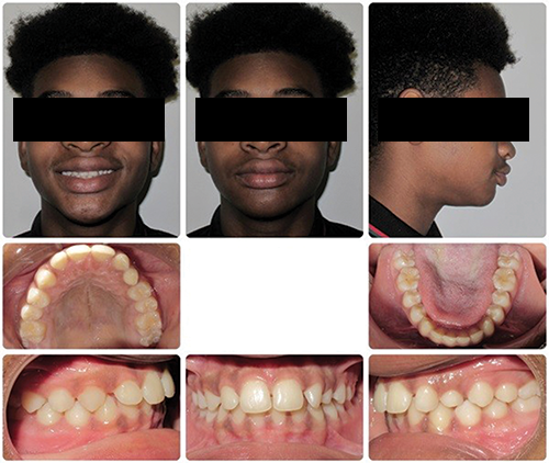 Will It Come Down on Its Own?