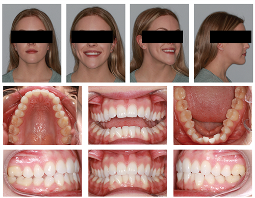 The Power of Anterior-Posterior Control with Clear Aligners