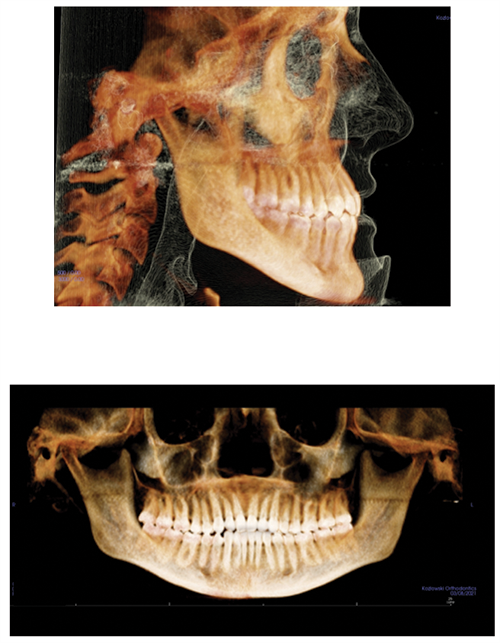 The Power of Anterior-Posterior Control with Clear Aligners