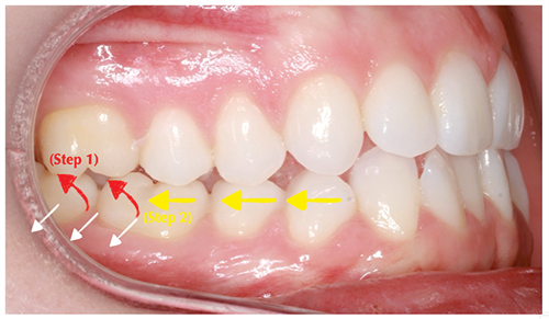 The Power of Anterior-Posterior Control with Clear Aligners
