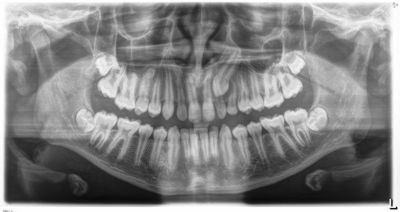 Will It Come Down on Its Own?