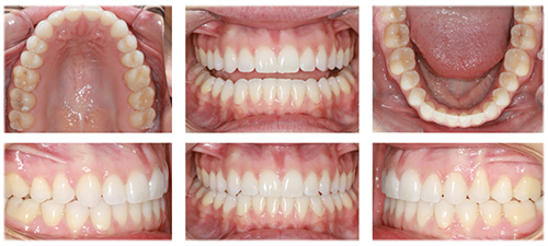 The Power of Anterior-Posterior Control with Clear Aligners