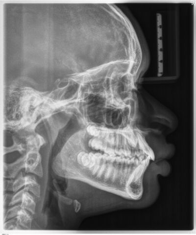 Will It Come Down on Its Own?