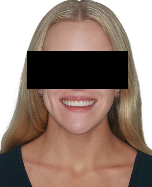 The Power of Anterior-Posterior Control with Clear Aligners