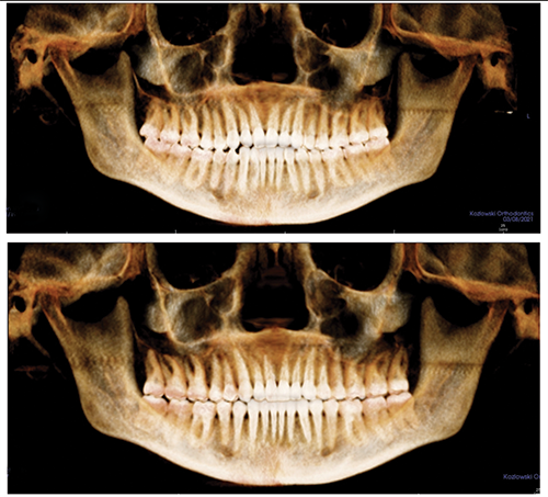 The Power of Anterior-Posterior Control with Clear Aligners