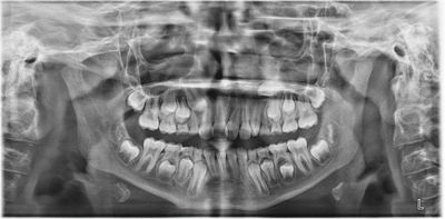 Will It Come Down on Its Own?