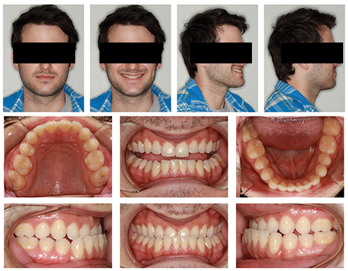 The Power of Anterior-Posterior Control with Clear Aligners