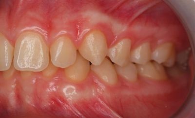 Will It Come Down on Its Own?