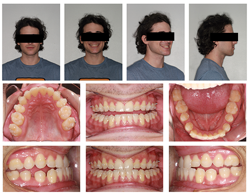 The Power of Anterior-Posterior Control with Clear Aligners
