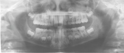 Will It Come Down on Its Own?