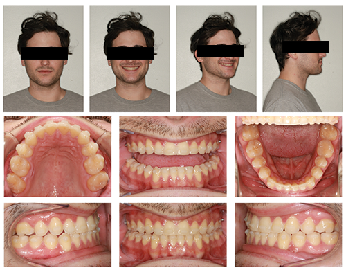 The Power of Anterior-Posterior Control with Clear Aligners