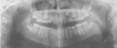 Will It Come Down on Its Own?