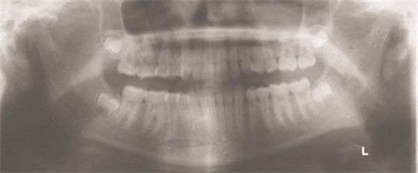 Will It Come Down on Its Own?