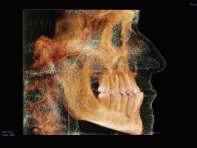 The Power of Anterior-Posterior Control with Clear Aligners