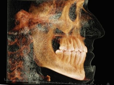 The Power of Anterior-Posterior Control with Clear Aligners