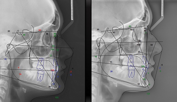 ‘Short-Face’ Patients—Part 2 by Dr. Chad Foster - Orthotown