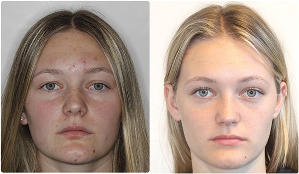 ‘Short-Face’ Patients—Part 2 by Dr. Chad Foster - Orthotown