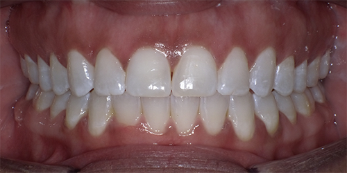 Open Bite Correction in an Adult Patient Using Clear Aligner Therapy