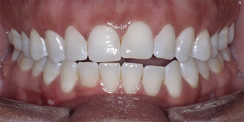 Open Bite Correction in an Adult Patient Using Clear Aligner Therapy