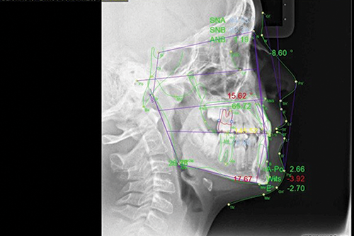 Managing a Young Class III with Crowding