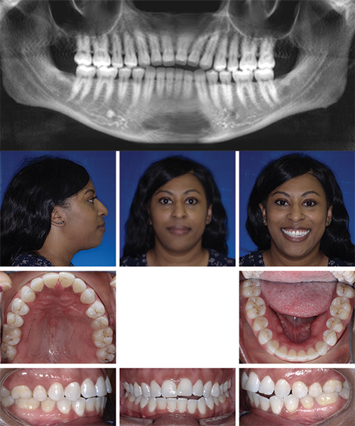 Open Bite Correction in an Adult Patient Using Clear Aligner Therapy