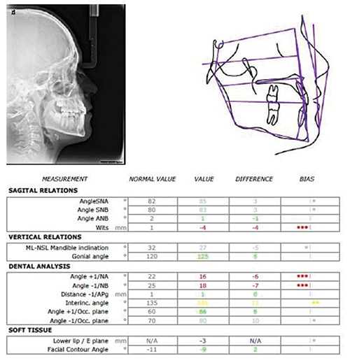 Managing a Young Class III with Crowding