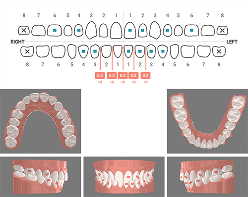 Open Bite Correction in an Adult Patient Using Clear Aligner Therapy