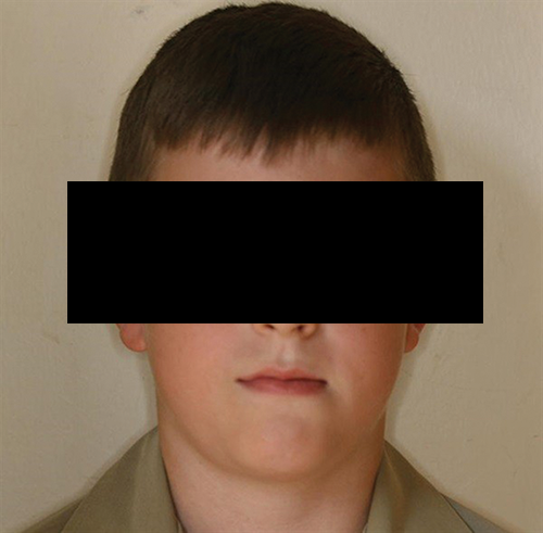 Managing a Young Class III with Crowding