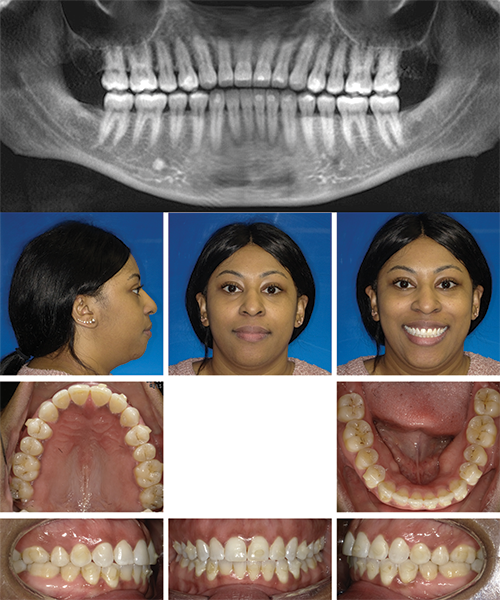 Open Bite Correction in an Adult Patient Using Clear Aligner Therapy