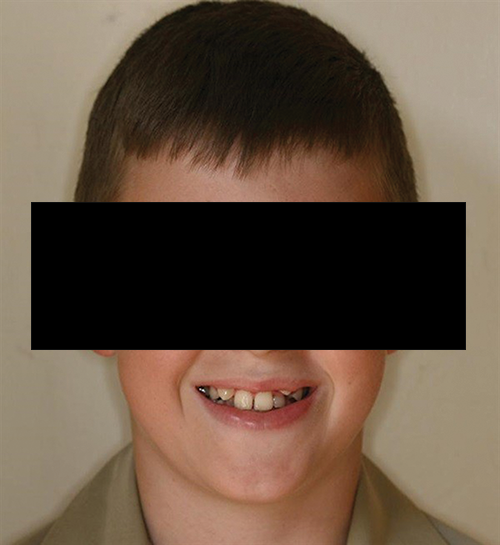 Managing a Young Class III with Crowding