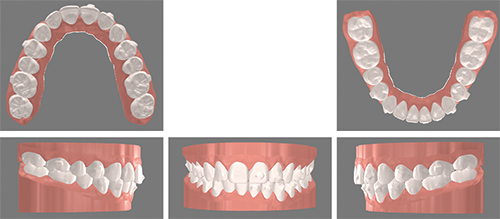 Open Bite Correction in an Adult Patient Using Clear Aligner Therapy