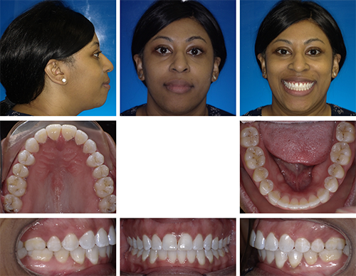 Open Bite Correction in an Adult Patient Using Clear Aligner Therapy