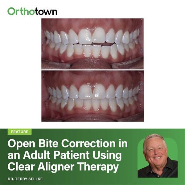 Open Bite Correction in an Adult Patient Using Clear Aligner Therapy