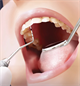 by Lorraine Frey, RDH, LDH, BAS Periodontal Probes: An Overview of History, Evolution and Clinical Technique 