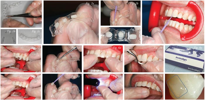 Aligner Attachment Bonding Technique Reduces Flash and Failure Mark  Perelmuter, DMD, MS, Bradley Goldberg, DMD and Dee Holloman - Orthotown