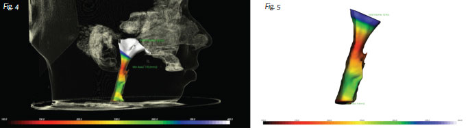 Fix Overbite & Increase Airway Volume in Huntington, NY